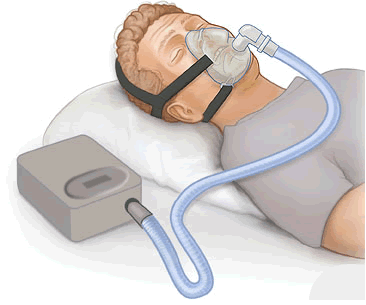 Dispositivos para apnea del sueño